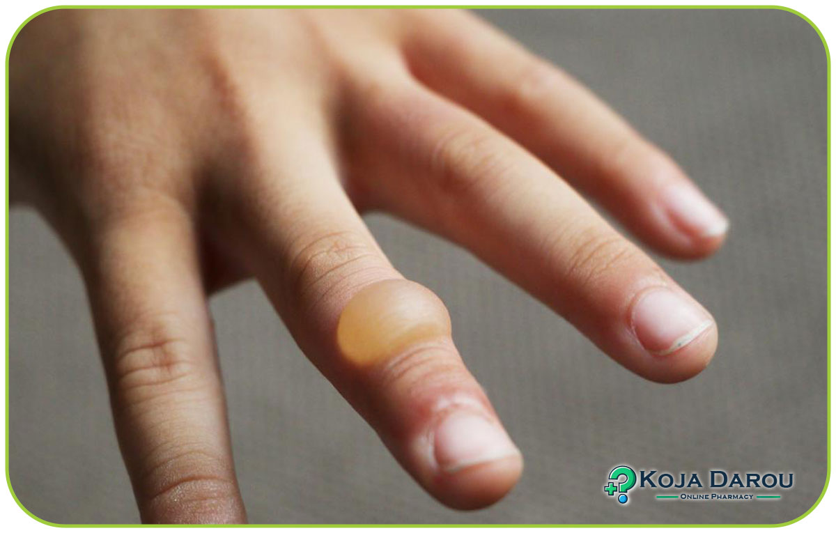 درمان خانگی سوختگی با روغن